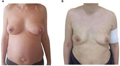 Breast cancer in pregnancy: concurrent cesarean section, nipple-sparing mastectomy, and immediate breast reconstruction—case report